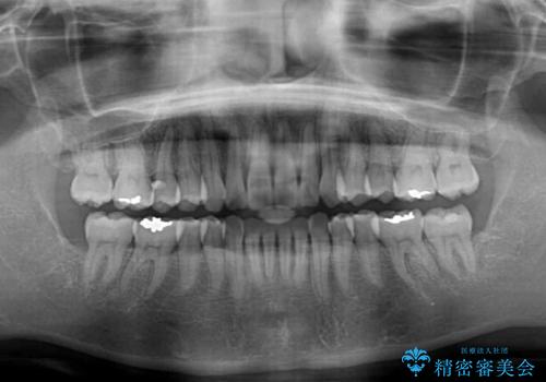 短期間で仕上げたい ワイヤーでの非抜歯矯正の治療後
