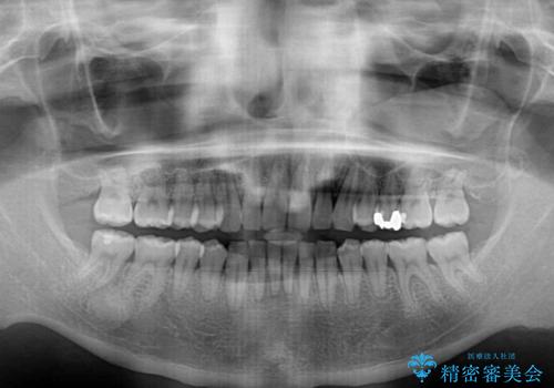 上顎の出っ歯とすきっ歯　補助装置を用いたインビザライン矯正の治療後