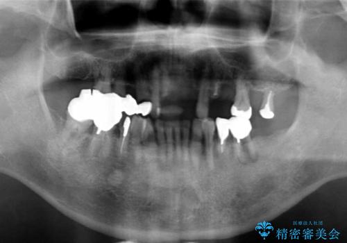 交通事故で前歯が折れた マグネットデンチャー 50代男性の治療前
