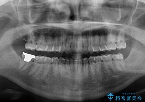 骨格的に左右にずれいている　前歯のデコボコをインビザラインで解消の治療後
