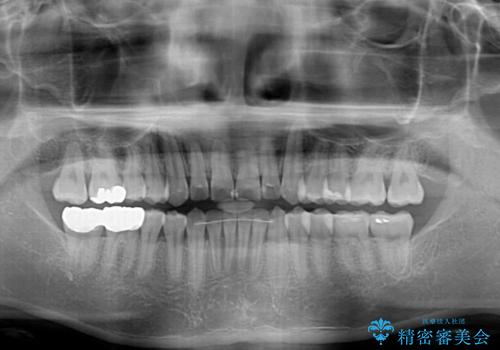 冷たいものがしみて奥歯が痛い 気になる歯並びも治したの治療後