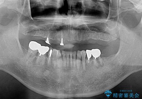 交通事故で前歯が折れた マグネットデンチャー 50代男性の治療後