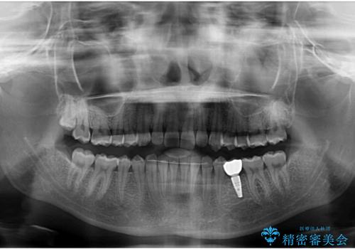 乳歯を抜いてインプラントに 咬み合わせ改善のインビザライン矯正の治療後