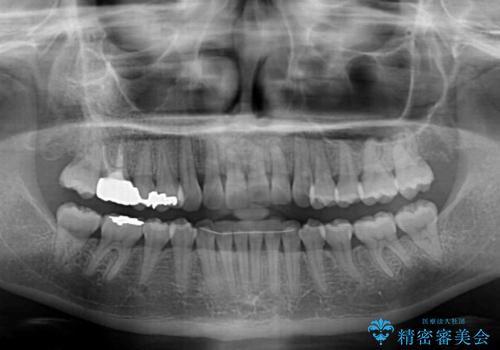 前歯のクロスバイト　インビザライン矯正で改善の治療後