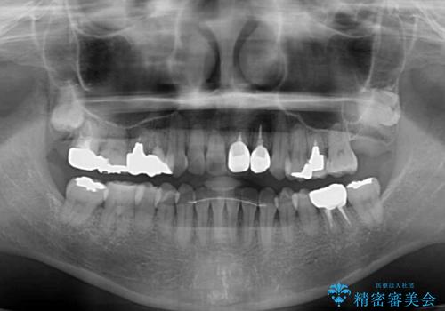 反対咬合で痛む前歯を改善 インビザラインによる矯正治療の治療後