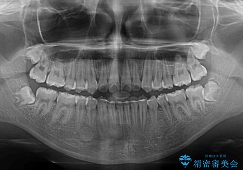 遠方から新幹線で通院 急速拡大装置とインビザラインによる矯正治療の治療後