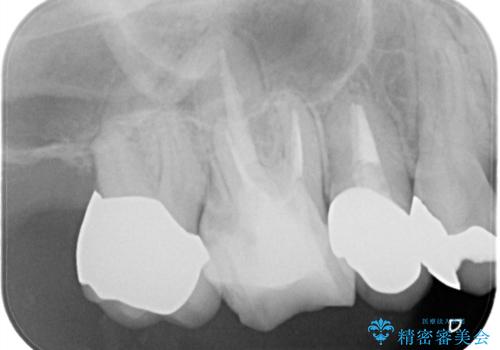 メタルボンドクラウンによる虫歯の治療の治療後