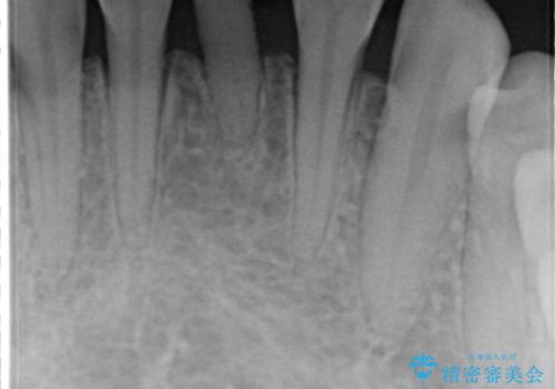 【前歯ブリッジ】下顎前歯の先天性欠如の補綴治療の治療前