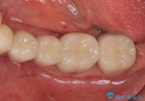 少ない残存歯質　抜歯ギリギリの歯を残すの治療後