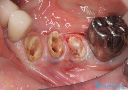 少ない残存歯質　抜歯ギリギリの歯を残すの治療中