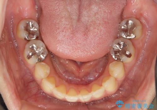 笑った時の印象を変えるメタルフリー治療の症例 治療前