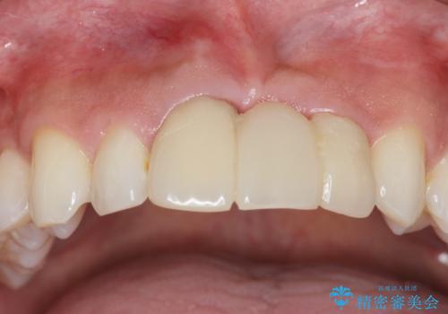 [ 審美歯科 ]前歯のブリッジをやりかえたいの症例 治療前