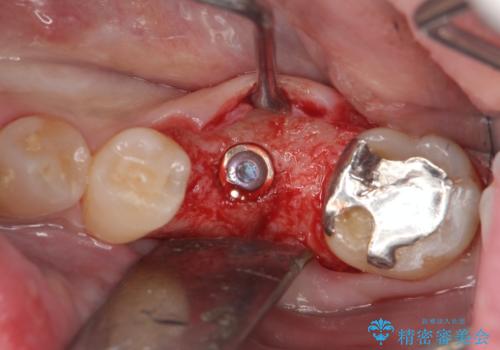 強い噛み合わせによる歯牙破折後のインプラント治療の治療中