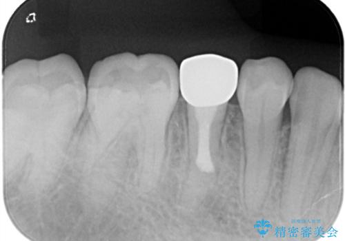 【サイナストラクト】歯肉に膿の出口がある歯の治療の症例 治療後