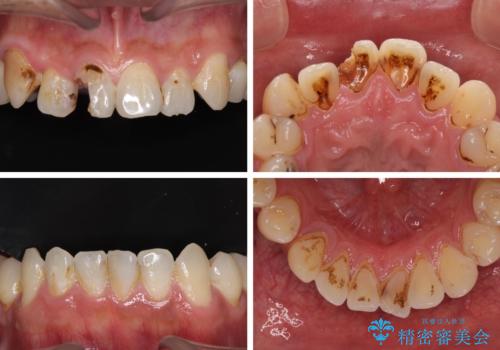とにかく作り物のような真っ白な歯にしたい フルジルコニアクラウンによる補綴治療の治療前