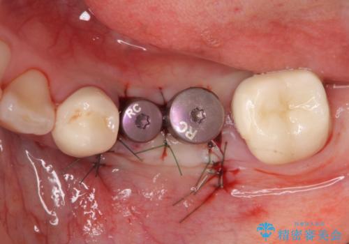 [ 2歯連続欠損 ] インプラントによる機能回復　の治療中