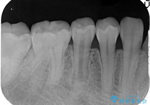 【サイナストラクト】歯肉に膿の出口がある歯の治療の症例 治療前