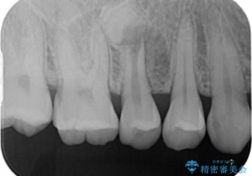 【中心結節破折】MTAセメントを用いたアペキシフィケーションの症例 治療前