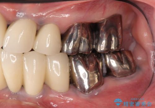 少ない残存歯質　抜歯ギリギリの歯を残すの症例 治療前