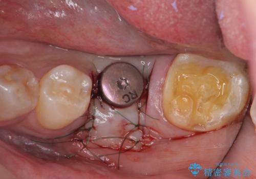 強い噛み合わせによる歯牙破折後のインプラント治療の治療中