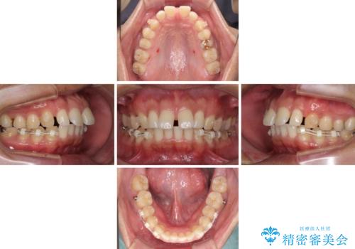 上顎の出っ歯とすきっ歯 補助装置を用いたインビザライン矯正の治療中