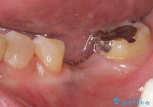 強い噛み合わせによる歯牙破折後のインプラント治療の症例 治療前