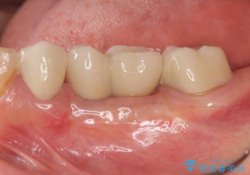 [ 2歯連続欠損 ] インプラントによる機能回復　の症例 治療後