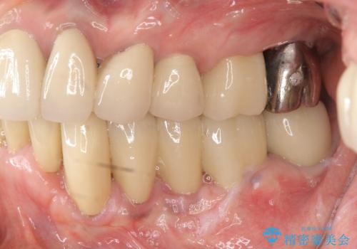 少ない残存歯質 抜歯ギリギリの歯を残す