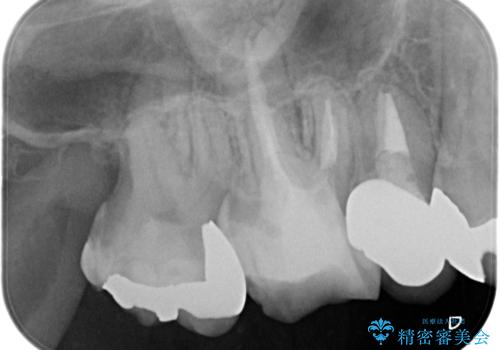 メタルボンドクラウンによる虫歯の治療の治療前