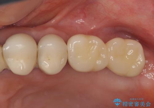 遊離端ブリッジ インプラント補綴への設計変更の治療後