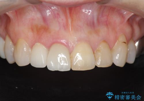 [ 前歯ジルコニアブリッジ ]  前歯の突き上げによる歯牙破折の症例 治療前