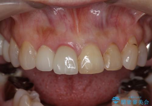 [ 前歯ジルコニアブリッジ ]  前歯の突き上げによる歯牙破折の治療前