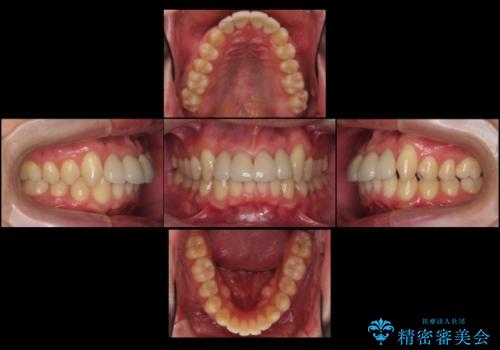 前歯のすき間 セラミックで綺麗に 最短で治療の治療後