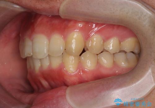 [ インビザライン ] マウスピース矯正で治す出っ歯の治療の治療後