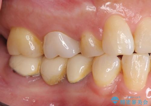 「ブリッジのところで噛むと痛い」 神経組織が原因の咬合痛の治療前