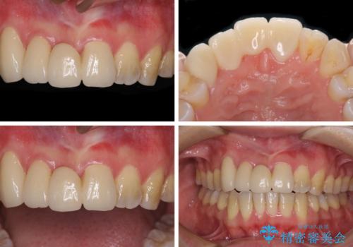 転んで前歯が欠けた 折れた前歯をきっかけに矯正治療で歯列をきれいに整えるの治療後