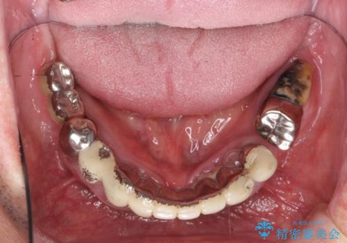 [ 重度歯周病 ] インプラント・義歯による咬合再構築の治療前