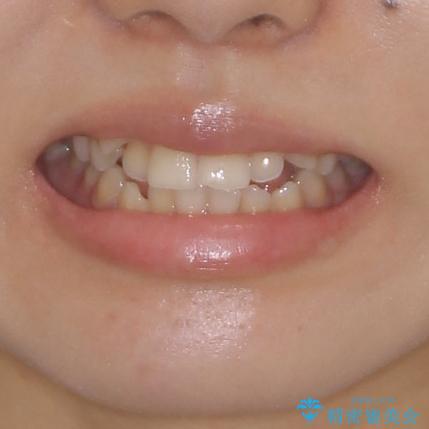 目立ちにくい抜歯矯正 ハーフリンガルの治療前(顔貌)