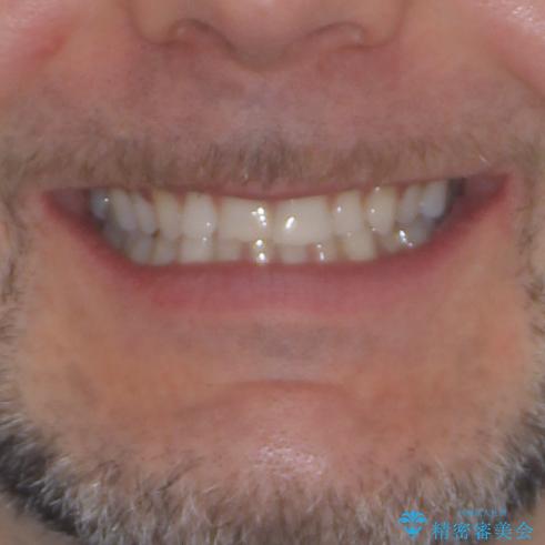 抜歯矯正の後戻りが気になる インビザライン・ライトによる矯正治療の治療前(顔貌)
