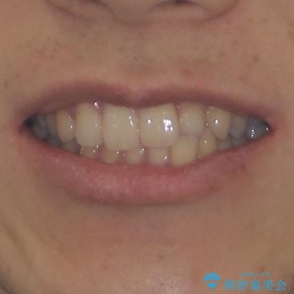 前歯のクロスバイトと抜歯が必要な奥歯の虫歯 インビザラインとインプラント治療の治療前(顔貌)