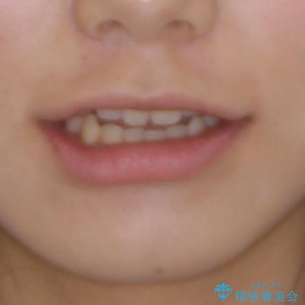 話しにくいオープンバイト ワイヤー装置による抜歯矯正治療の治療前(顔貌)