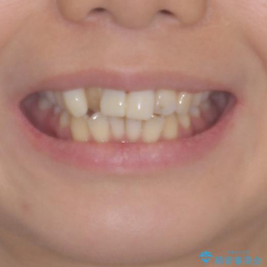 転んで前歯が欠けた 折れた前歯をきっかけに矯正治療で歯列をきれいに整えるの治療前(顔貌)