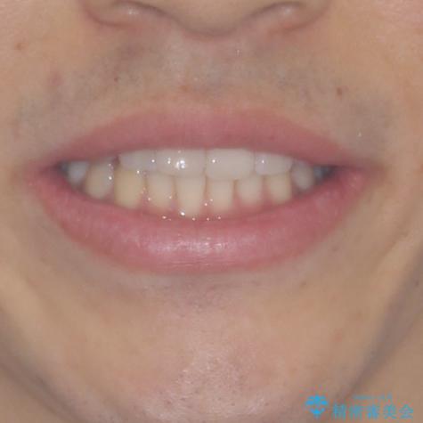 インビザライン・ライトによる矯正治療の後戻り改善の治療前(顔貌)