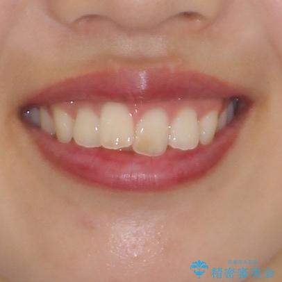 就職前にきれいな歯並びにしたい 大学生のインビザライン矯正の治療前(顔貌)