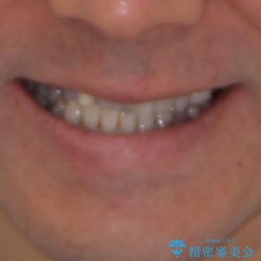 下の歯が前に出てしまう咬み合わせを治したい　インビザラインによる矯正治療の治療前（顔貌）
