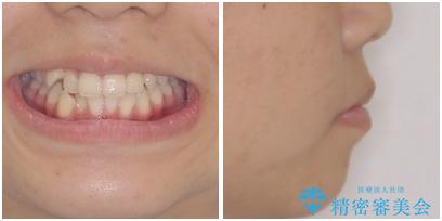 気がつくと口が開いてしまう 閉じにくい口元改善の抜歯矯正の治療前(顔貌)