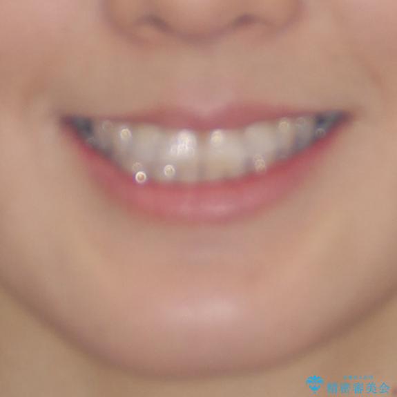 急速拡大装置で奥歯の咬み合わせを改善 インビザラインによる矯正治療の治療前(顔貌)