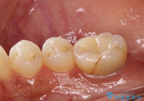 【オールセラミック】奥歯が痛い。根管治療〜被せ物治療の治療前