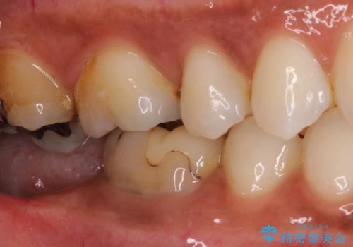 【オールセラミック】奥歯が痛い。根管治療〜被せ物治療の治療前