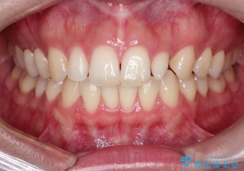 【矮小歯】オールセラミッククラウンの治療前